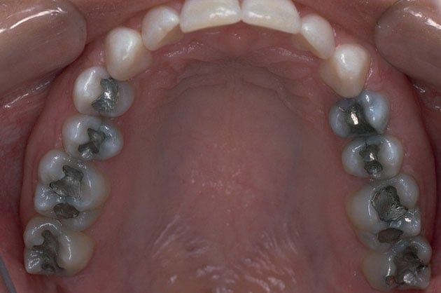 Tooth-colored composite filling before and after Before