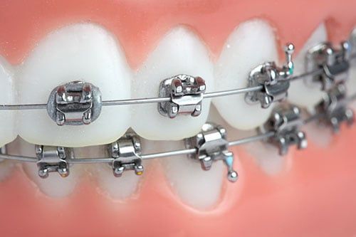 Metal braces on teeth