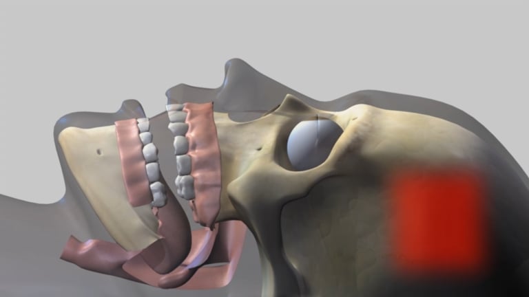 Diagram showing how the tongue blocks the airway during sleep apnea