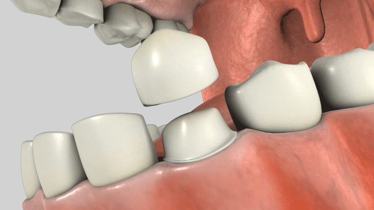 Crowns and fillings restoration close-up