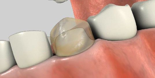 Preparing a tooth for a custom dental crown
