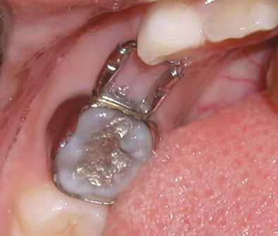 Space maintainer orthodontic appliance