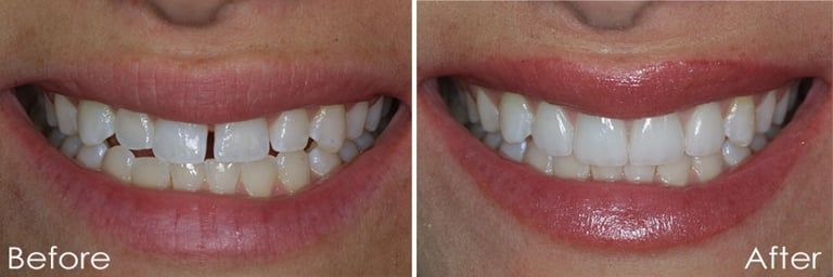 Smile makeover with porcelain veneers before and after