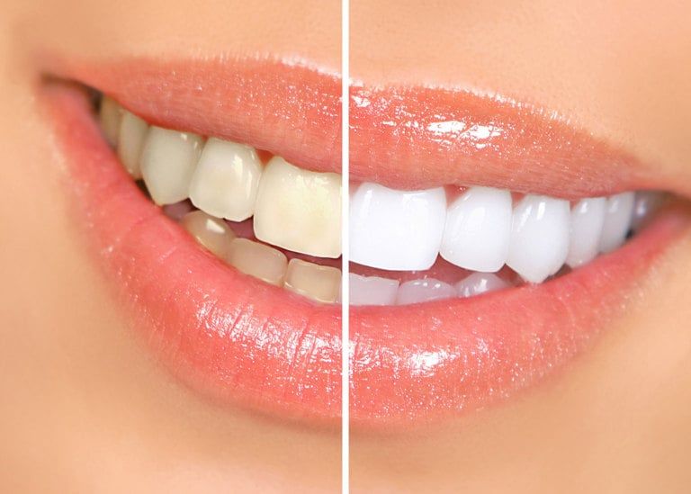 Professional teeth whitening result at Azari & Zahedi Dentistry in Jacksonville